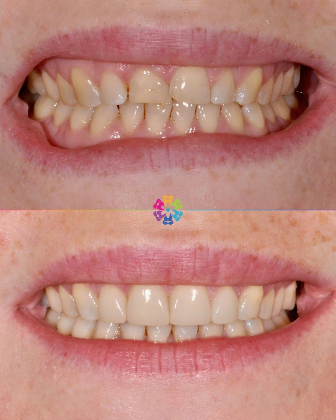 Invisalign Transformation by Dr Dan Golebiowski 🦷

This patient&rsquo;s current biting position caused excessive wear, resulting in the teeth appearing shorter

To correct this, Dan used Invisalign to get the teeth in the correct position and finish