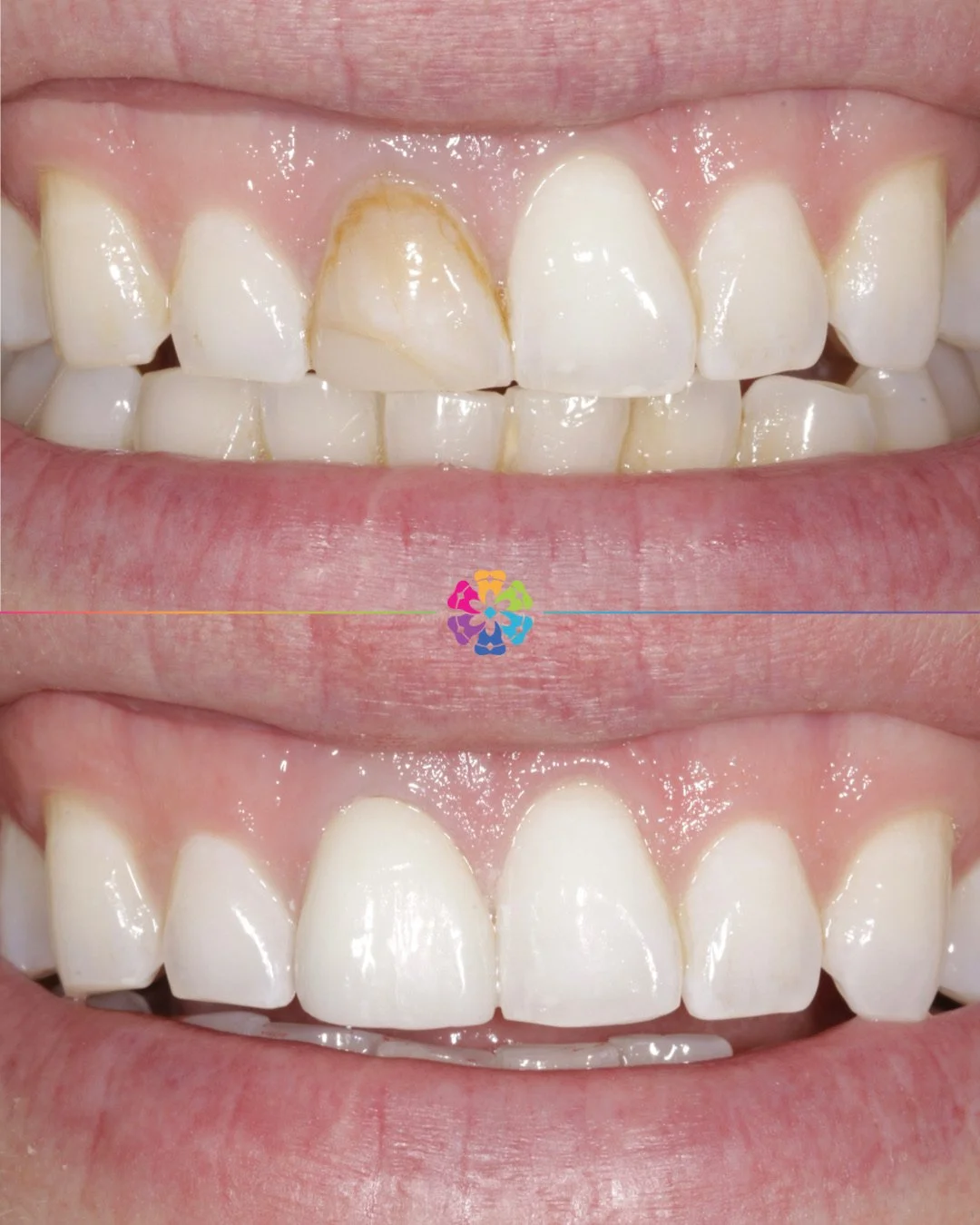 Front Tooth Veneer 🦷

After having root canal treatment, the tooth can darken as a result. This patient experienced this and wanted to improve the appearance.

Dr Sharpe resolved this by doing a veneer to mask the discolouration 💫

#dentist #dental