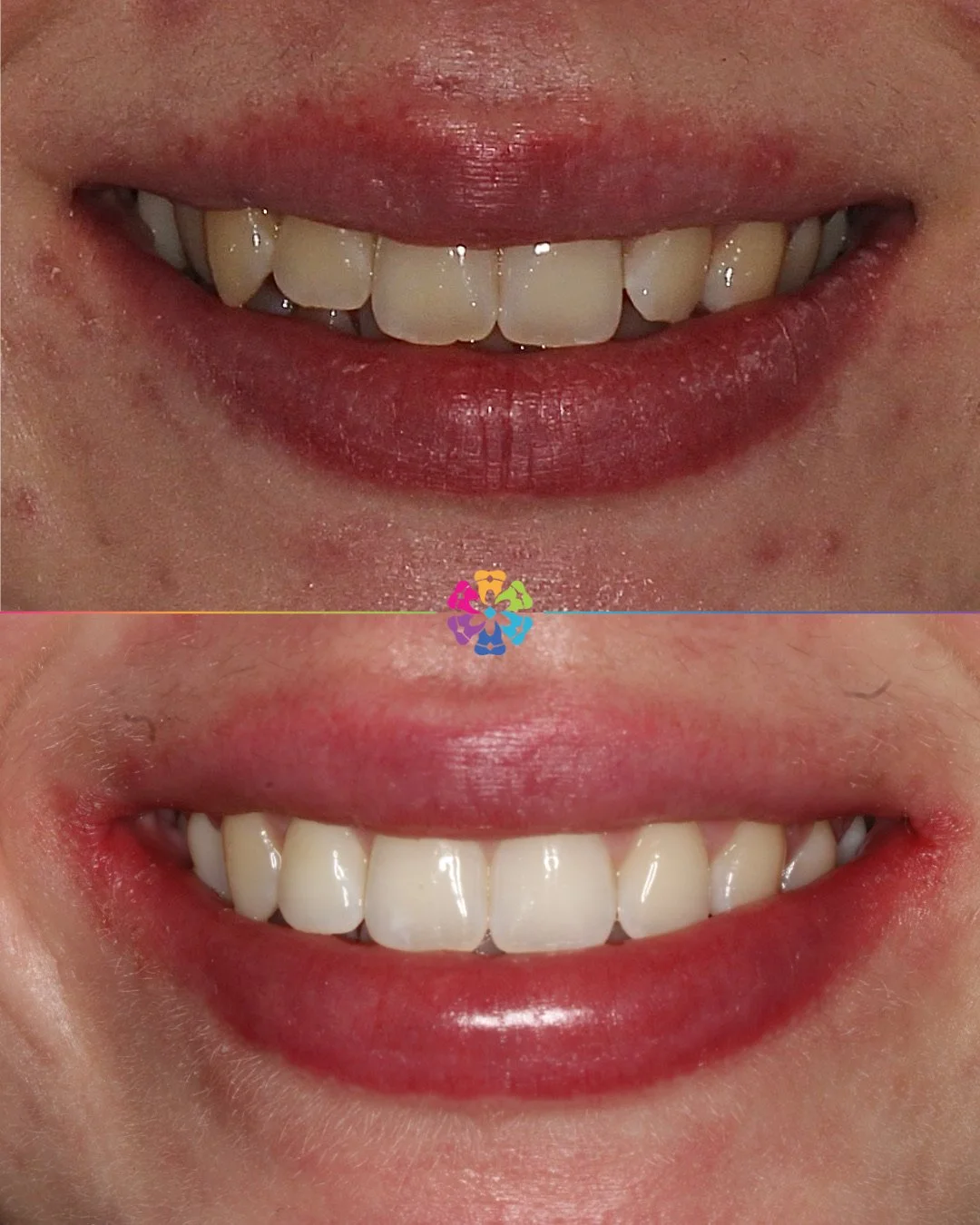 Invisalign Magic 🪄 

Completed in just 10 months 🦷

#dentist #dentalsmiles #dentalsmilesessex #dentalsmileschelmsford #dentalsmilesessex #dentalsmilestakeley #essex #compositefillings #veneers #invisalign #invisaligndentist #straightteeth #braces #