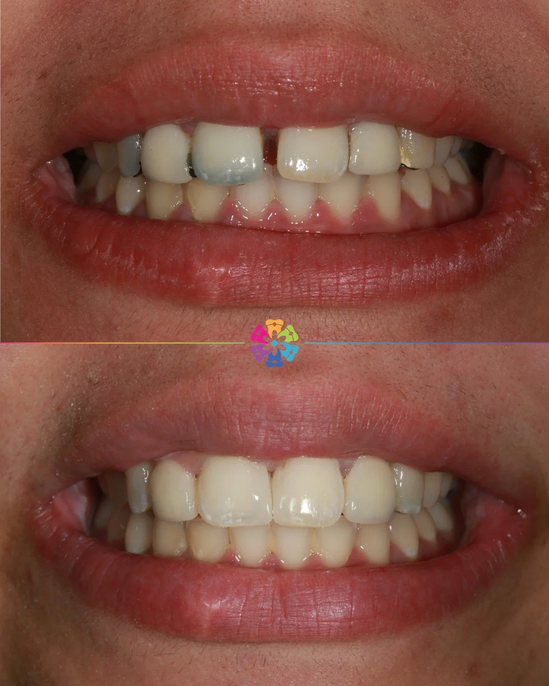 Smile Makeover 💫

This patient had two maryland bridges to replace the missing upper lateral incisors.

The metal wings were attached to the front tooth and canine on both sides, but the metal started to shine through the teeth, making it appear gre