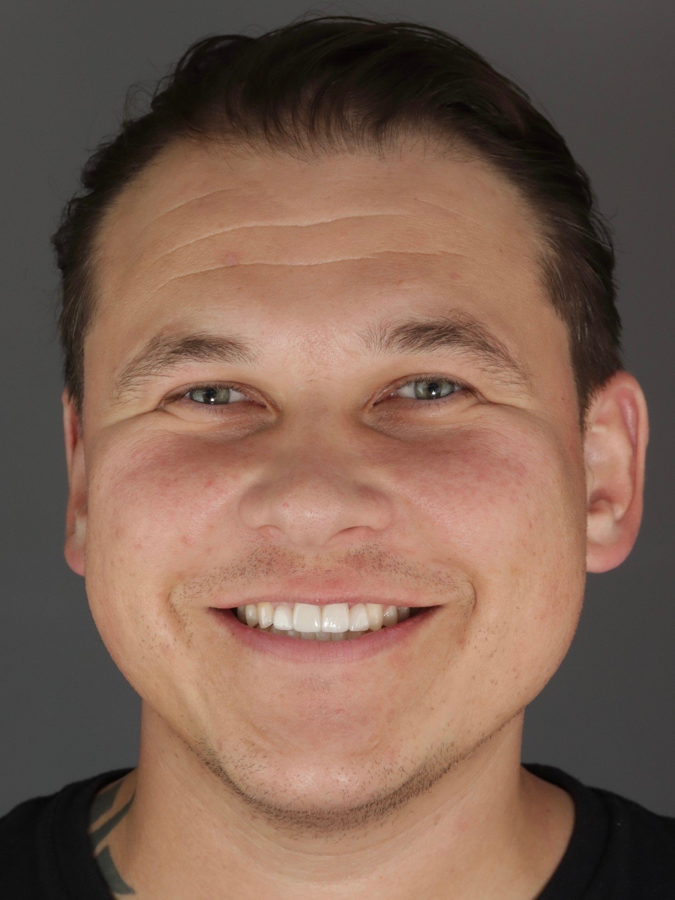 Smile Makeover ✨

What's involved?
��- Invisalign
��- Whitening
��- Crown Replacement (UR2)
��- Porcelain Veneers (UR1 &amp; UL1)
��- Zirconia Maryland with white wing (UL2)

#dentist #dentalsmiles #dentalsmilesessex #dentalsmileschelmsford #dentalsm