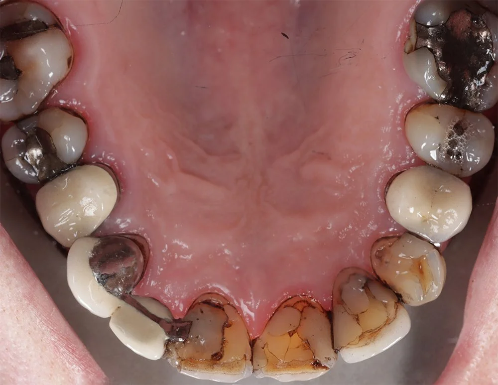 How do I prevent tooth decay?