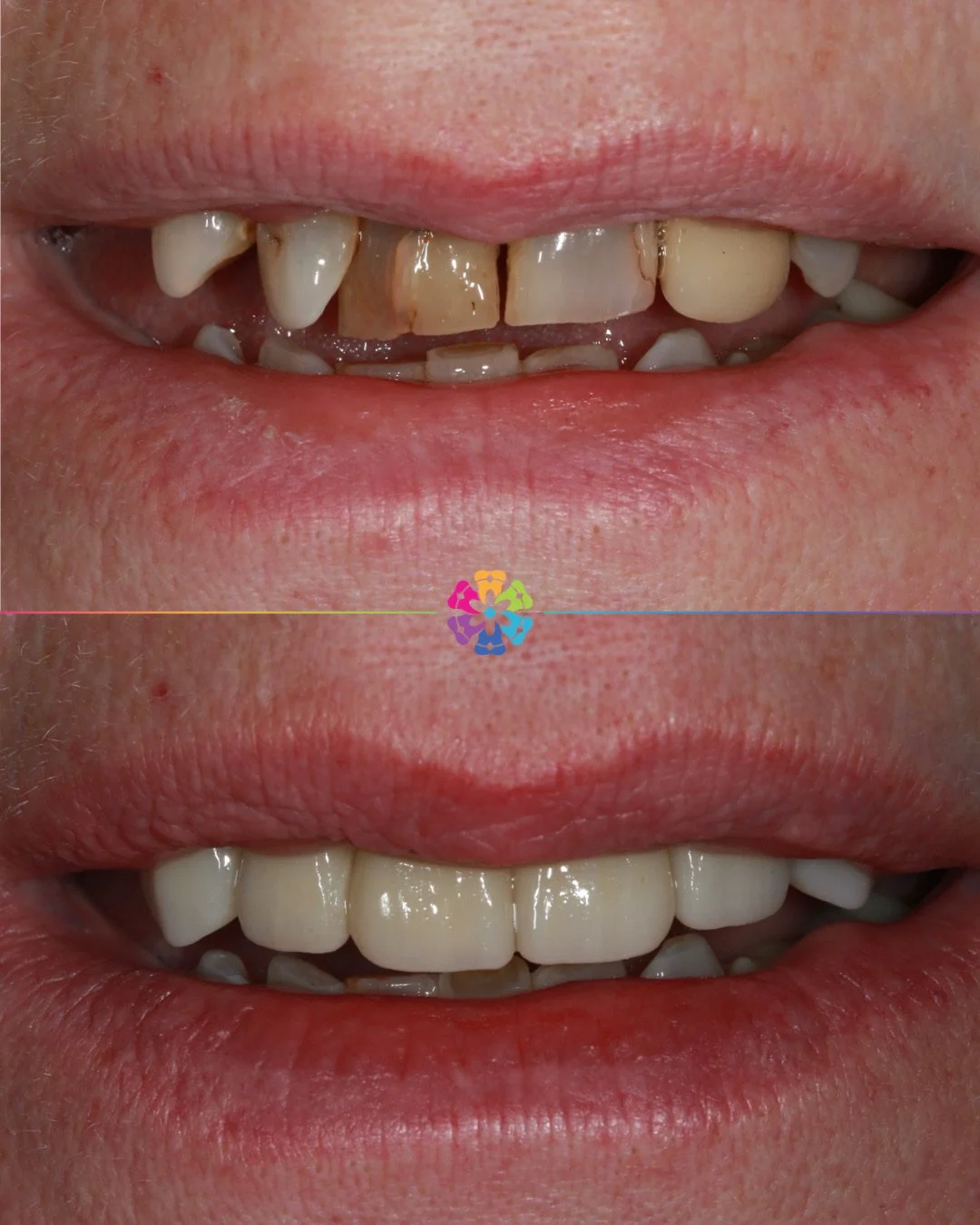 Smile Makeover ✨

This patient wanted to improve the cosmetics of the front teeth. 

Incredible results by Dr Andy Sharpe 🦷

#dentist #dentalsmiles #dentalsmilesessex #dentalsmileschelmsford #dentalsmilesessex #dentalsmilestakeley #essex #compositef