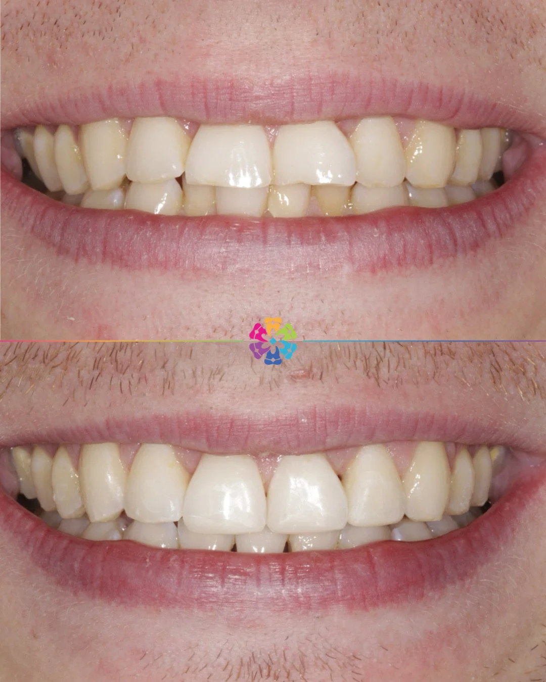 Invisalign Magic ✨ 

How was this achieved? 

1. Lower incisor was removed to allow the teeth to align
2. Invisalign used to straighten the smile
3. Whitening
4. Composite edge bonding on the upper incisors

Bespoke smile by Dr Andy Sharpe 

#dentist