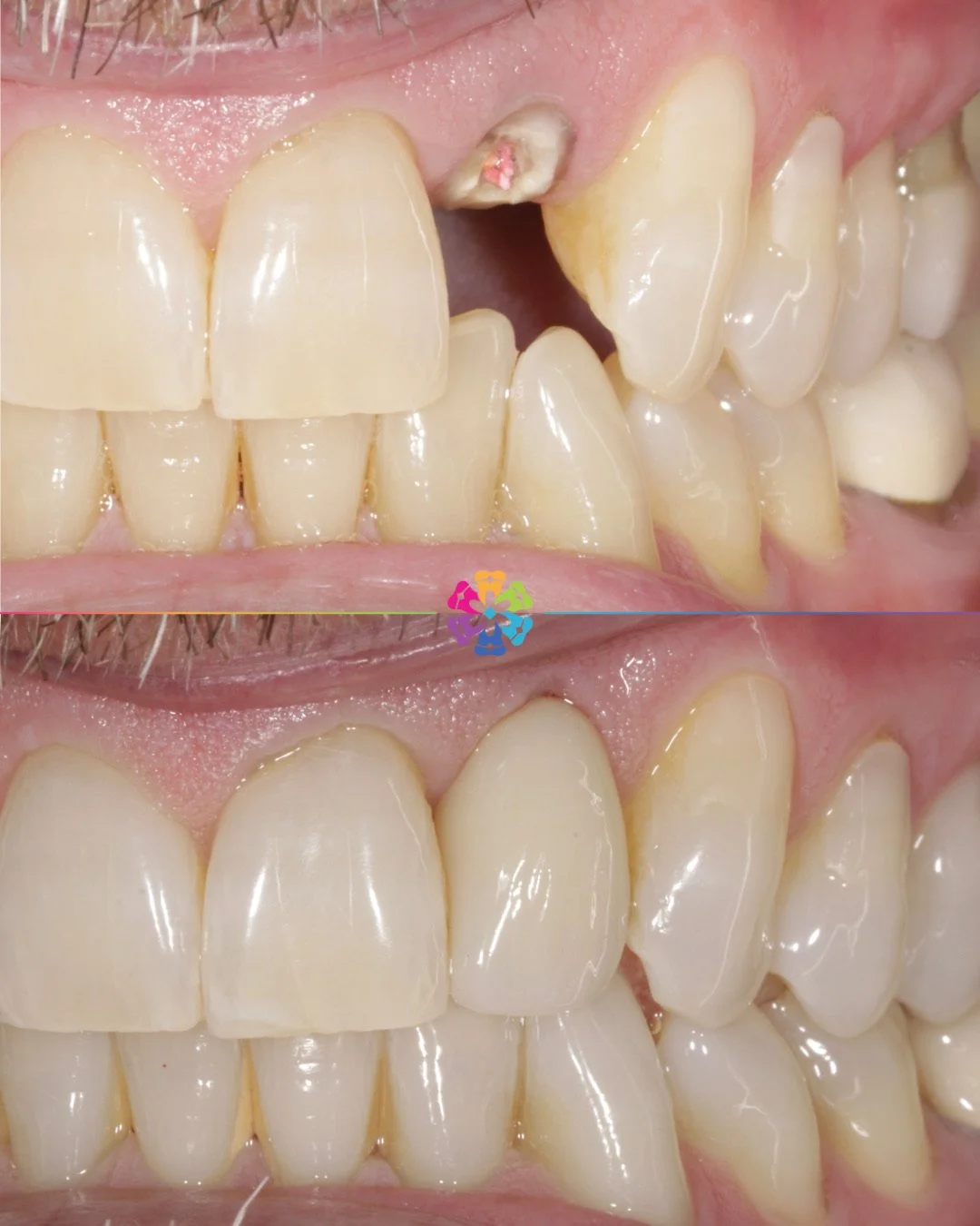 Immediate Implant, immediate confidence ✨

This patient had the root extracted, bone graft, implant placed and immediate loading all in one appointment!

Benefits of immediate implants/loading:

✔️ Patients can leave the practice with a fully functio