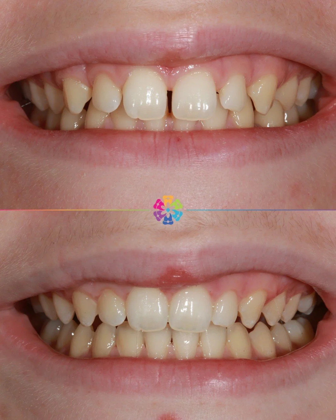 Teenage Invisalign 🧑🏽&zwj;🦱🦷

Just 9 months from the consultation, this smile was complete! 

Less than a year of clear braces for a smile that lasts a lifetime ✨

#dentalsmilesessex #teenageinvisalign #clearbraces #orthodontic #invisalign