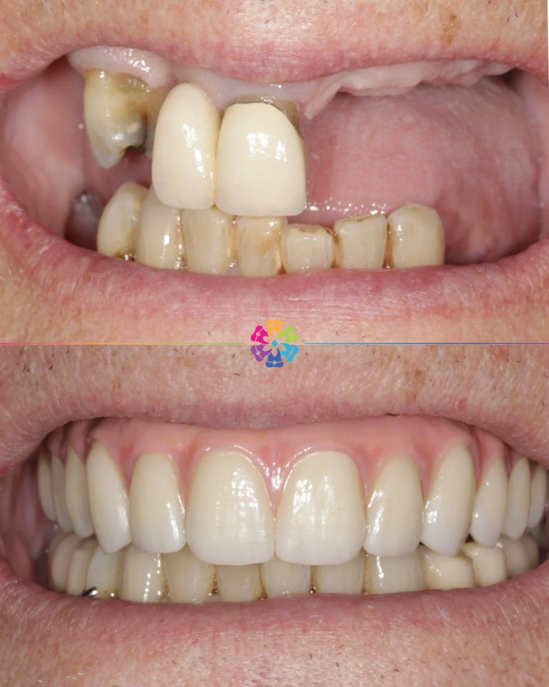 Implant Case 🔩🦷

This patient had a full arch implant bridge on 5 implants

Restoring function back to the patient and a fixed solution!

No more taking dentures out at night, now the teeth stay put!

We offer implant consultations, book in now! 📲