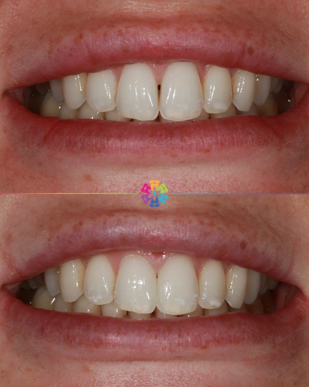 After orthodontic treatment, sometimes small triangles between the teeth (often called black triangles) can appear due to the shape of the teeth and the appearance when aligned 🔺

To fix this, black triangle closure is often used to minimise the gap