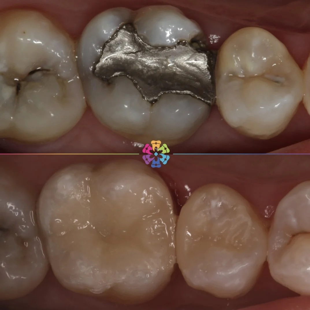 Composite Fillings 