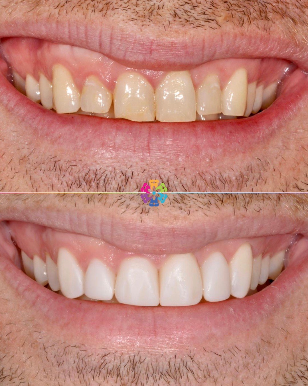 ✨Whitening &amp; Composite bonding✨

What an amazing before and after, completed using boutique whitening &amp; finishing with some composite bonding!

👨🏼&zwj;⚕️completed by Dr.Daniel Golebiowski 🦷
📍 Dental Smiles Takeley