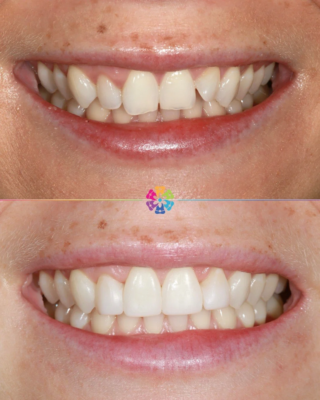 Another amazing before &amp; after case, to complete this stunning smile we used Invisalign, Whitening &amp; Composite bonding.

👨🏼&zwj;⚕️Completed by Manish Jagatiya
📍Dental Smiles Chelmsford

📧Dm for more info!

#dentalsmilesessex #invisalign #