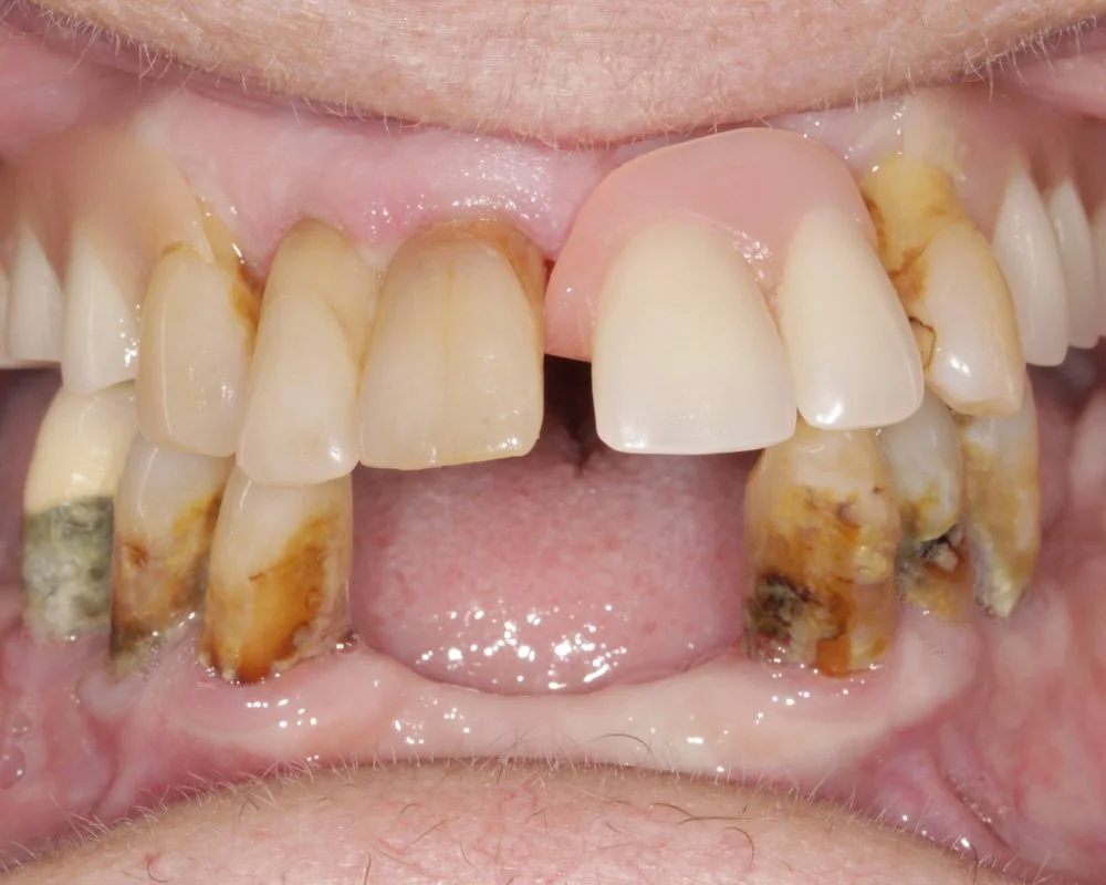 Dental Smiles Implant-Retained Dentures