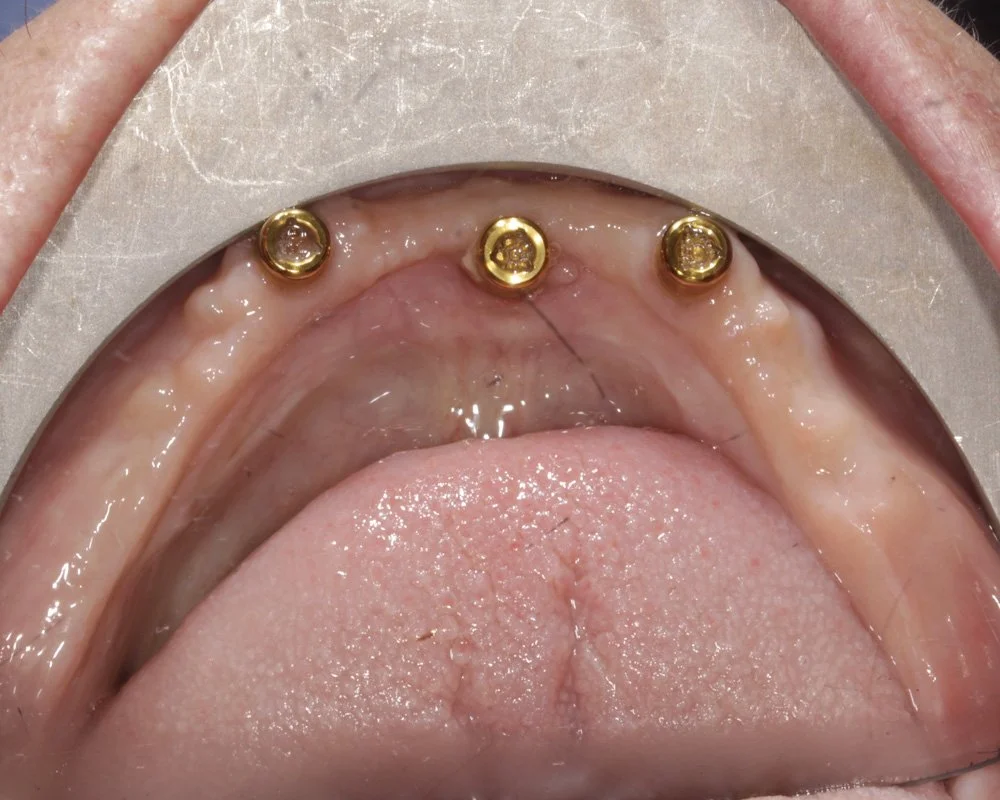 Dental-implant placement