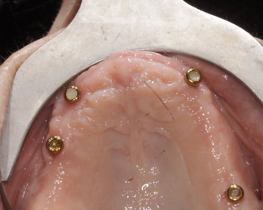 Dental-implant placement