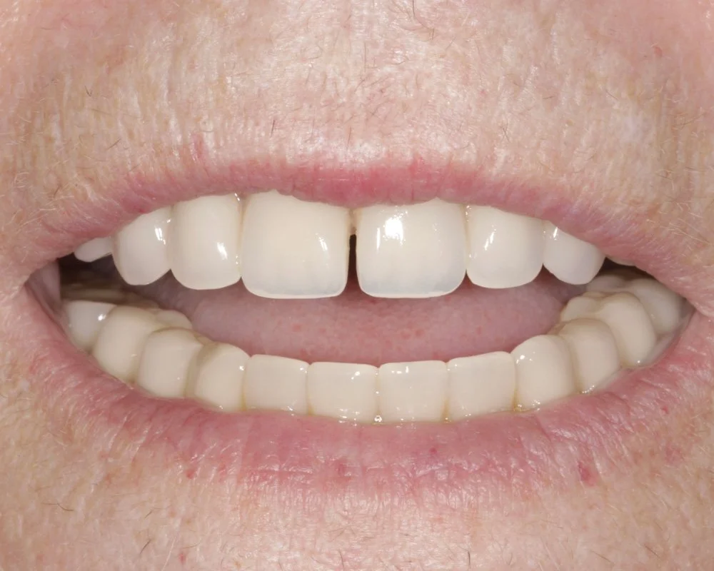 Final result of implant-retained denture placement with Dental Smiles