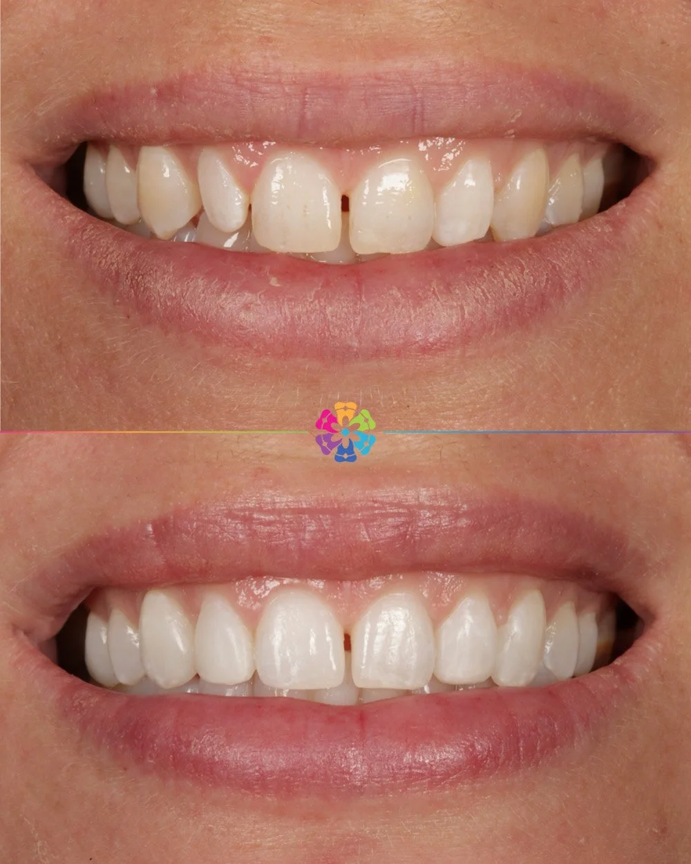 Composite Bonding