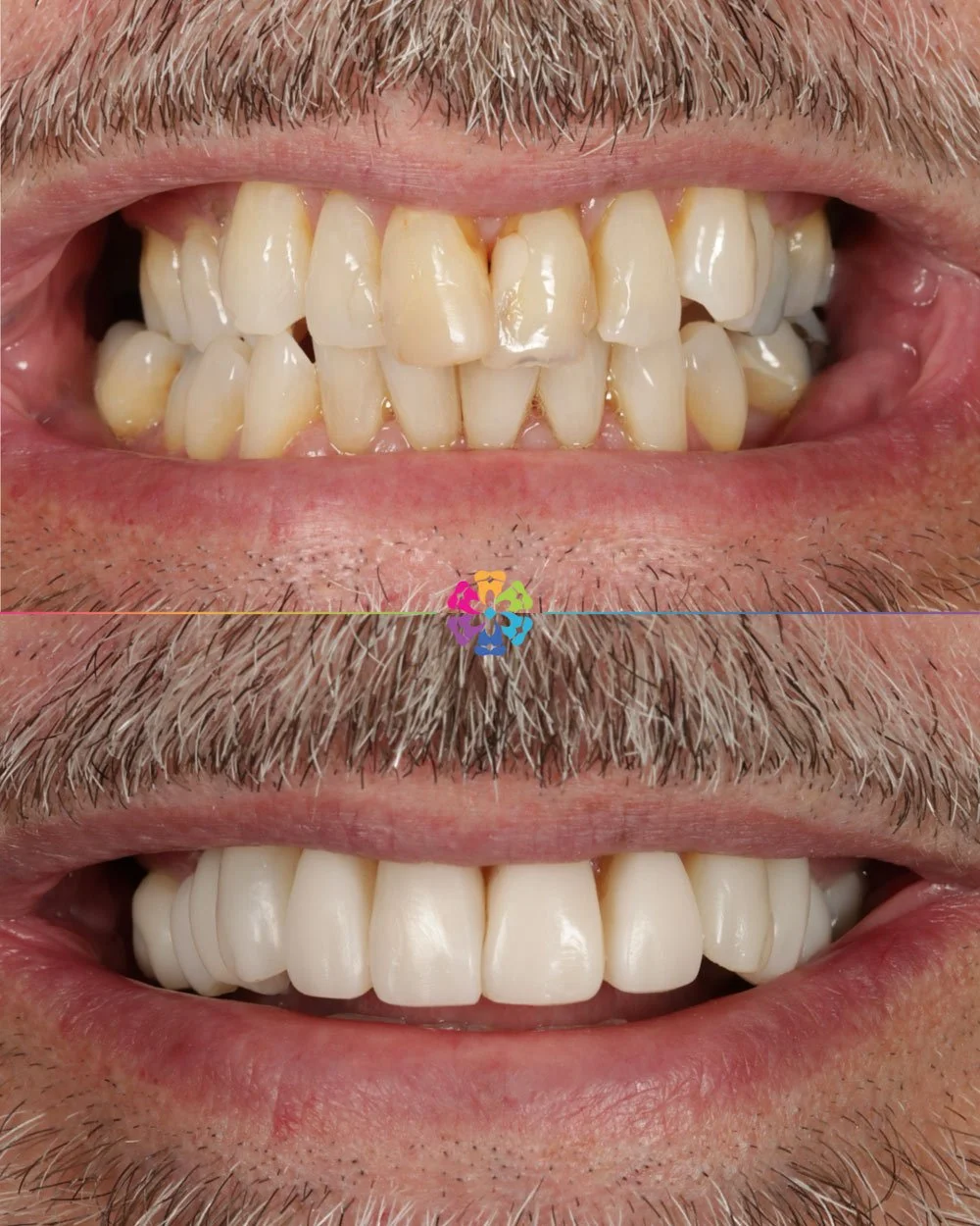 Composite Veneers at Dental Smiles