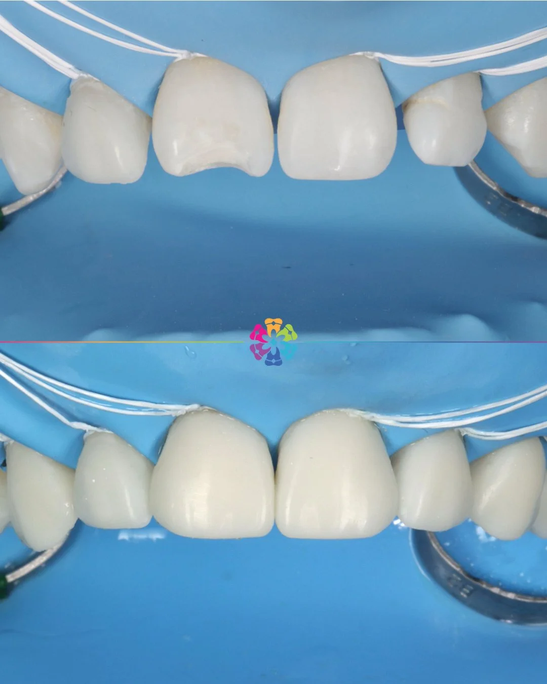 Composite Veneers at Dental Smiles