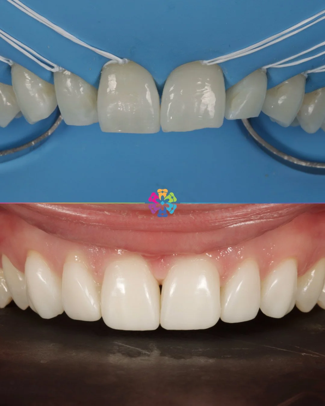 Composite Veneers at Dental Smiles