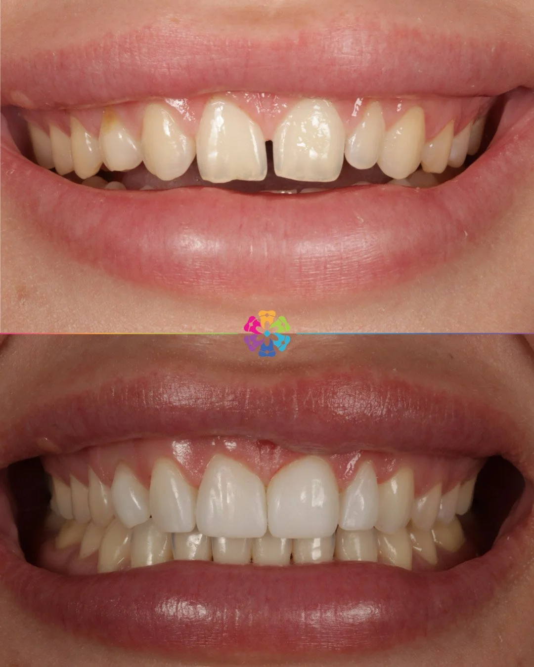 Composite Veneers at Dental Smiles