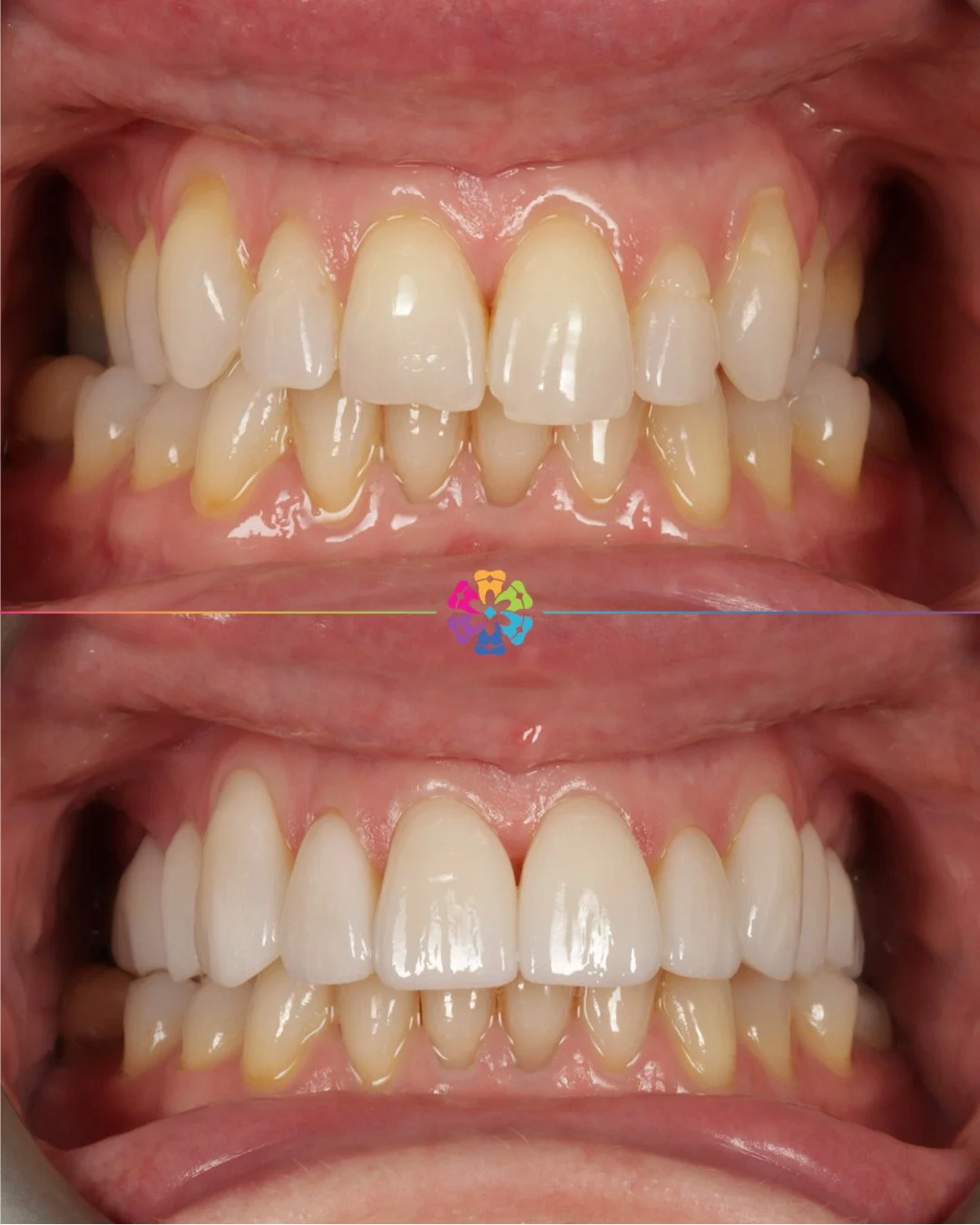 Porcelain Veneers