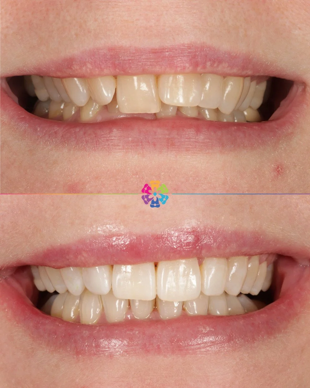 Invisalign and Whitening