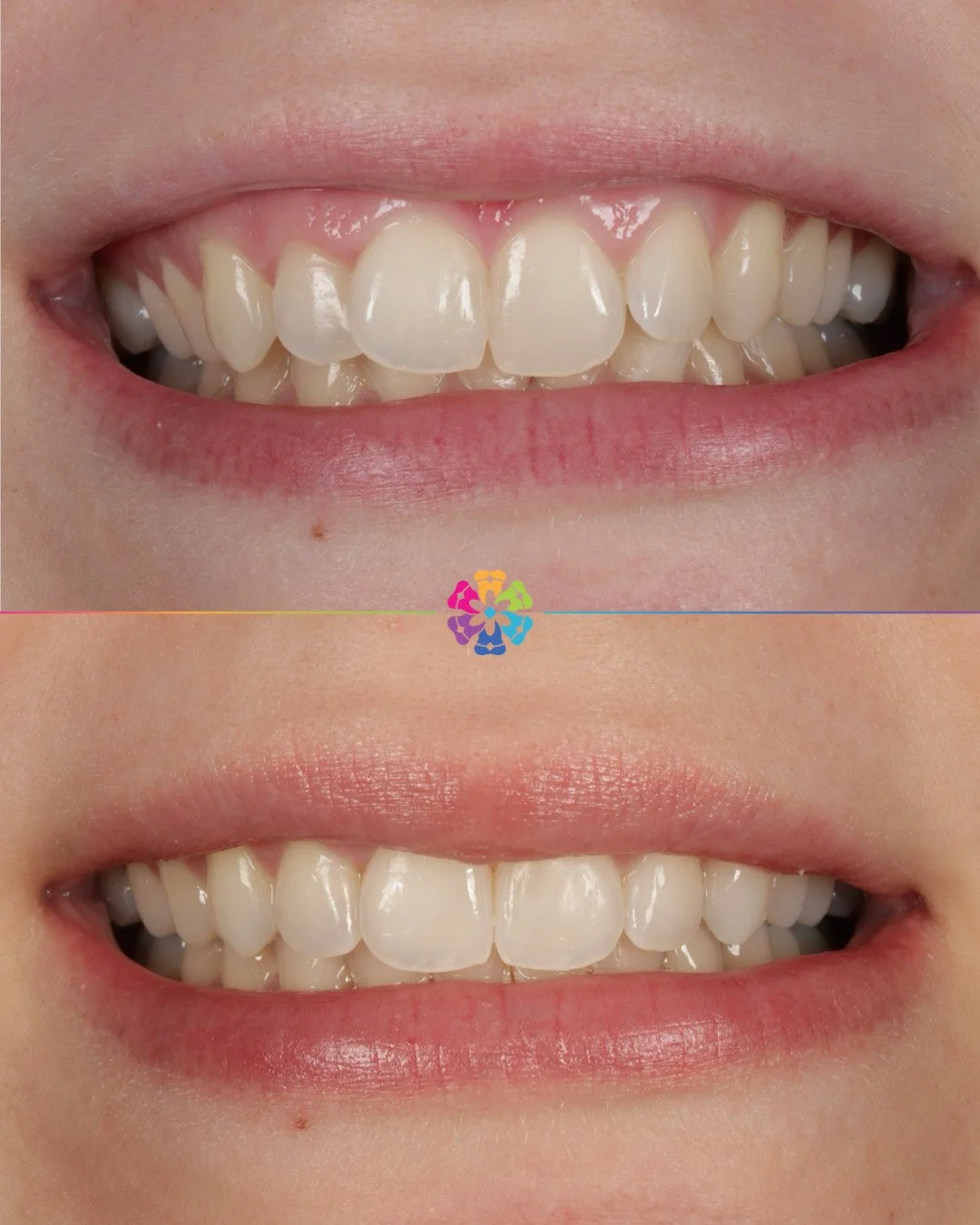 Invisalign and Whitening