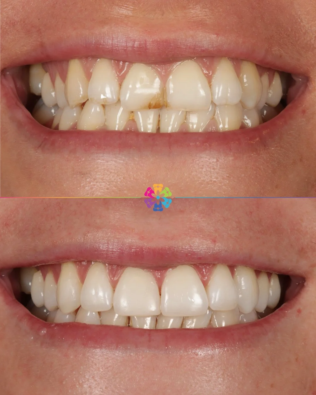 Invisalign, Whitening and Bonding