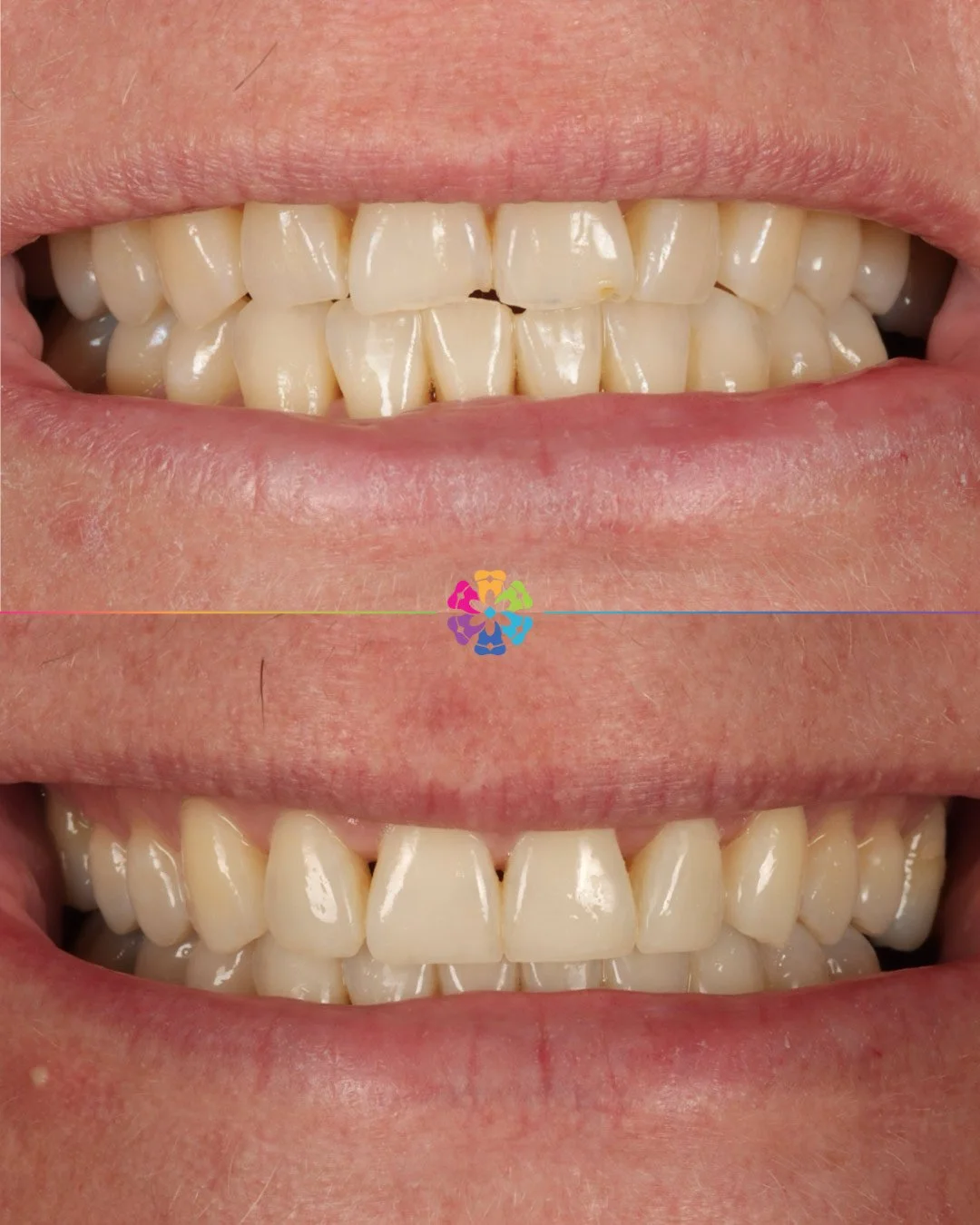 Invisalign, Whitening and Bonding