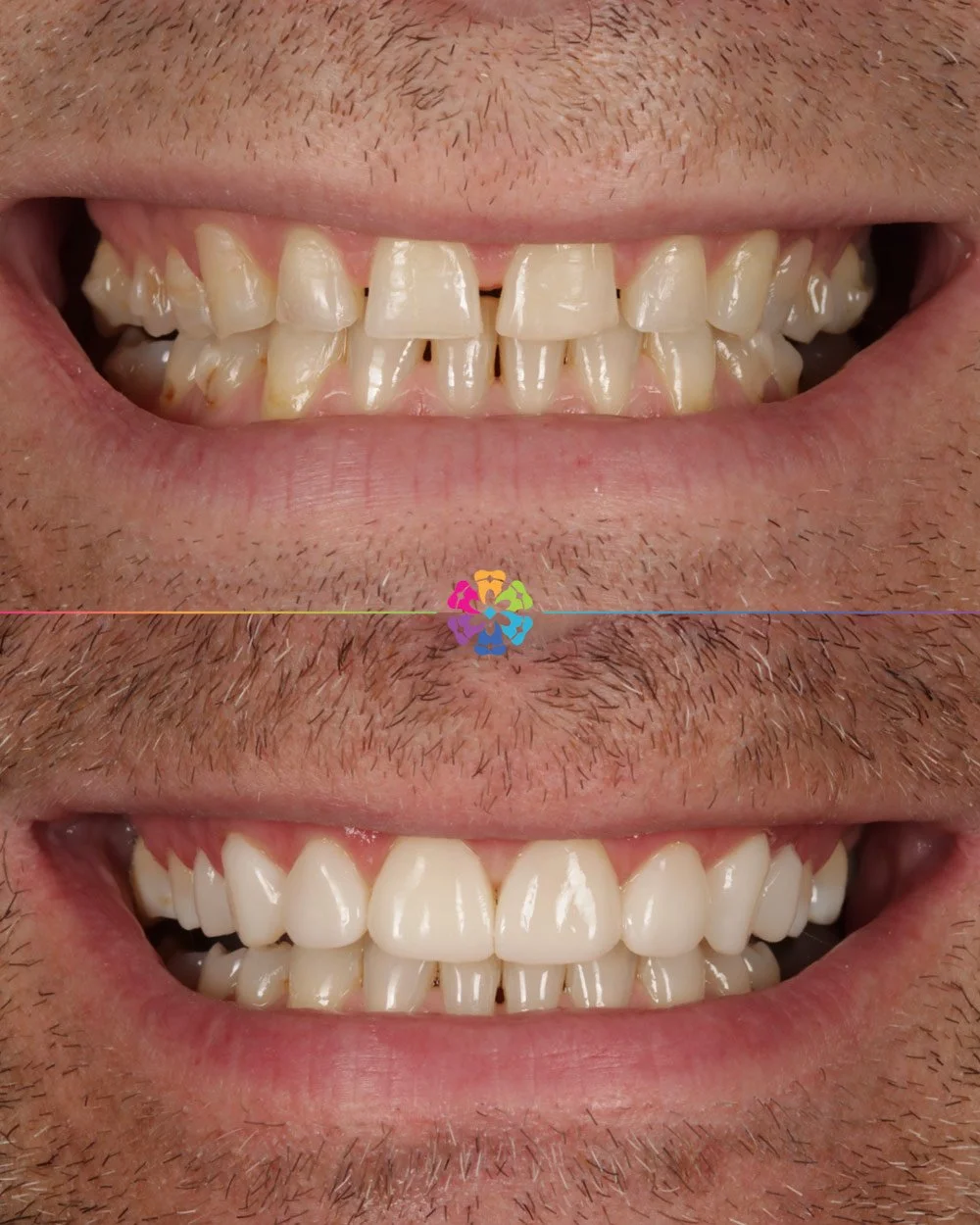 Smile Makeover