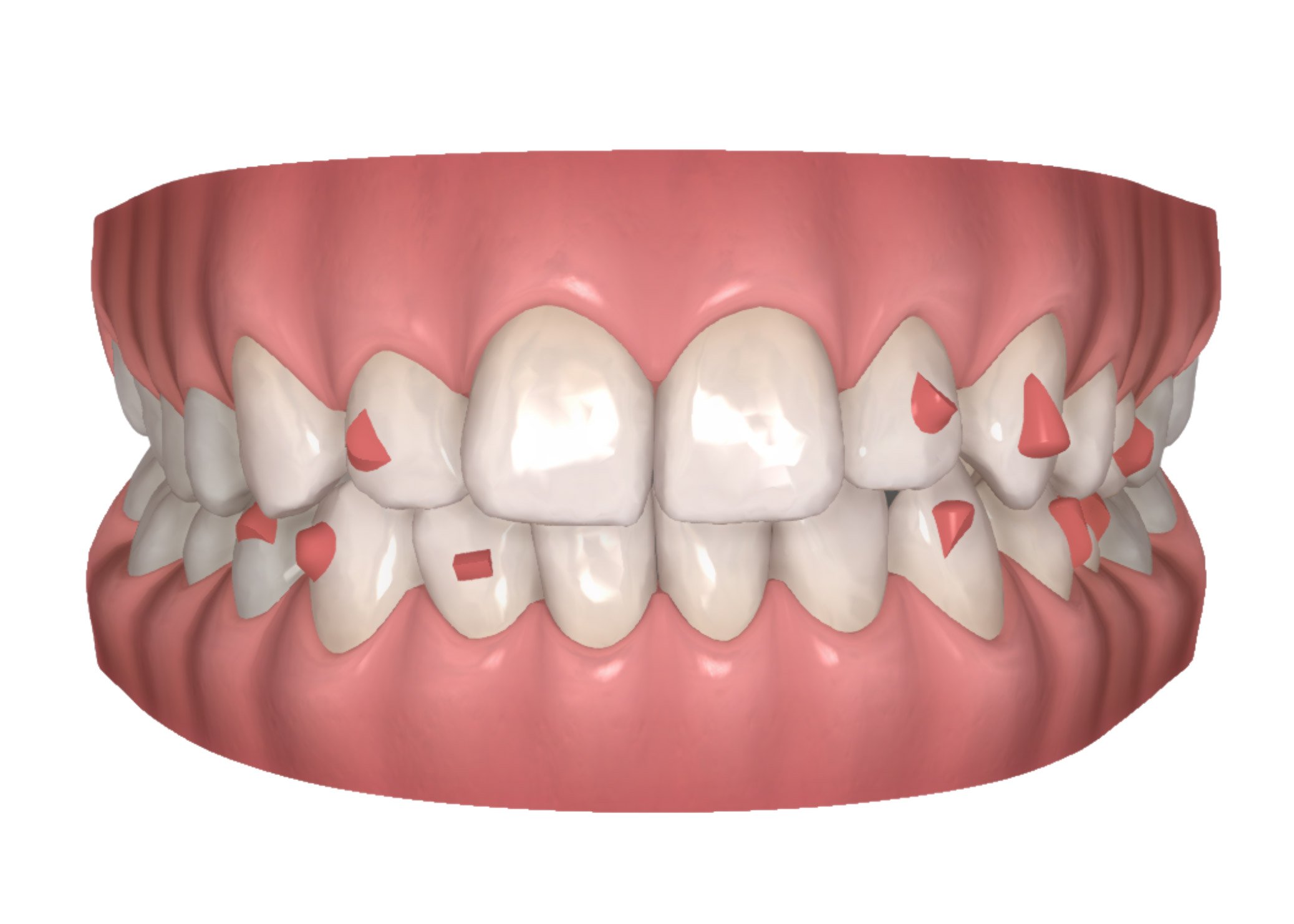 Dental Smiles Invisalign attachments