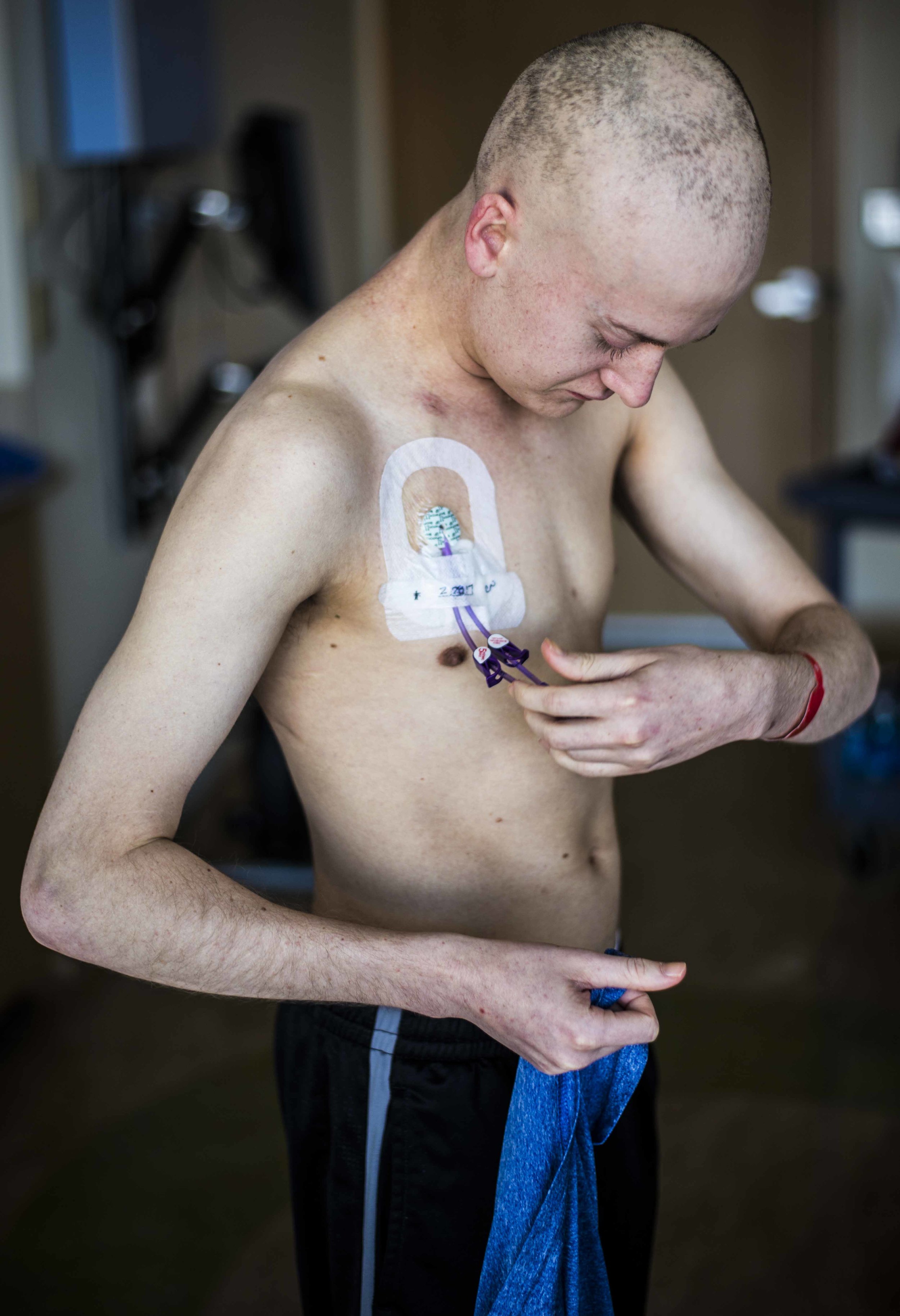  Tanner walks around the room after being attached to an IV pole for approximately 33 days, March 5. He took off his shirt to inspect his central line, the former bridge between him and the IV. 