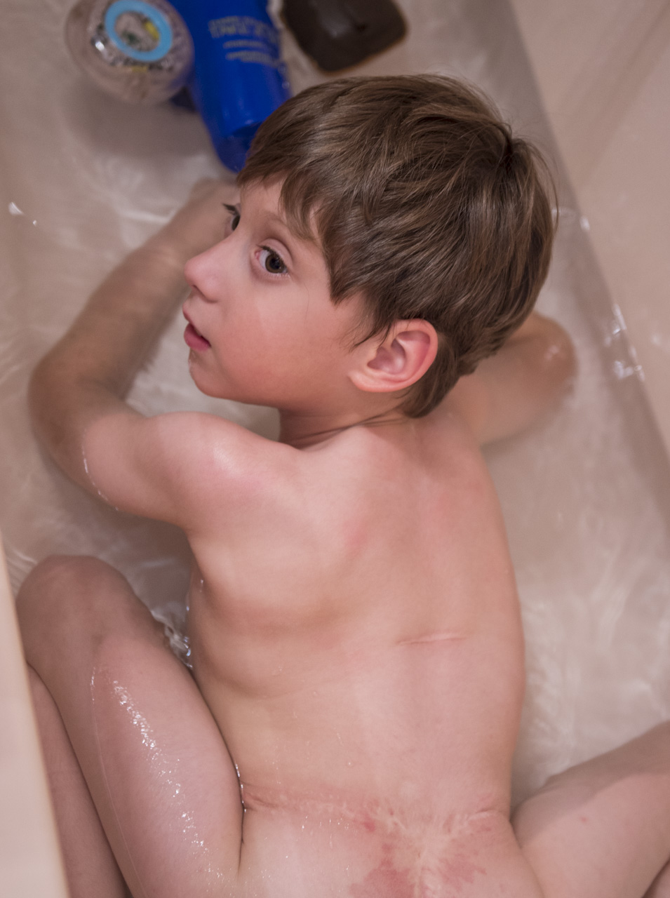  Five-year-old Josiah Fershee plays in the bathtub in his home in Charleston, W. Va. right before bed. The scars on his back illustrate what he has gone through since his birth. Josiah was born with a birth defect know as spina bifida myelomeningocel