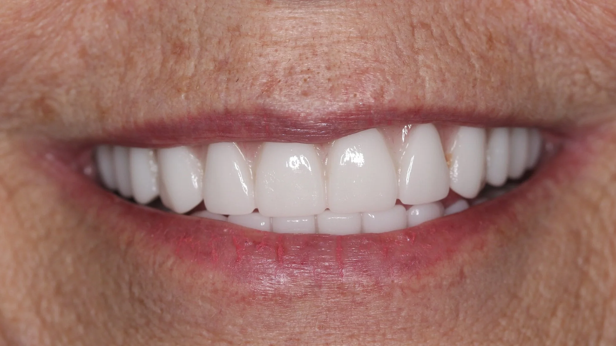 All-on-4 Dental Implants