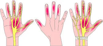 Carpal Tunnel.jpeg