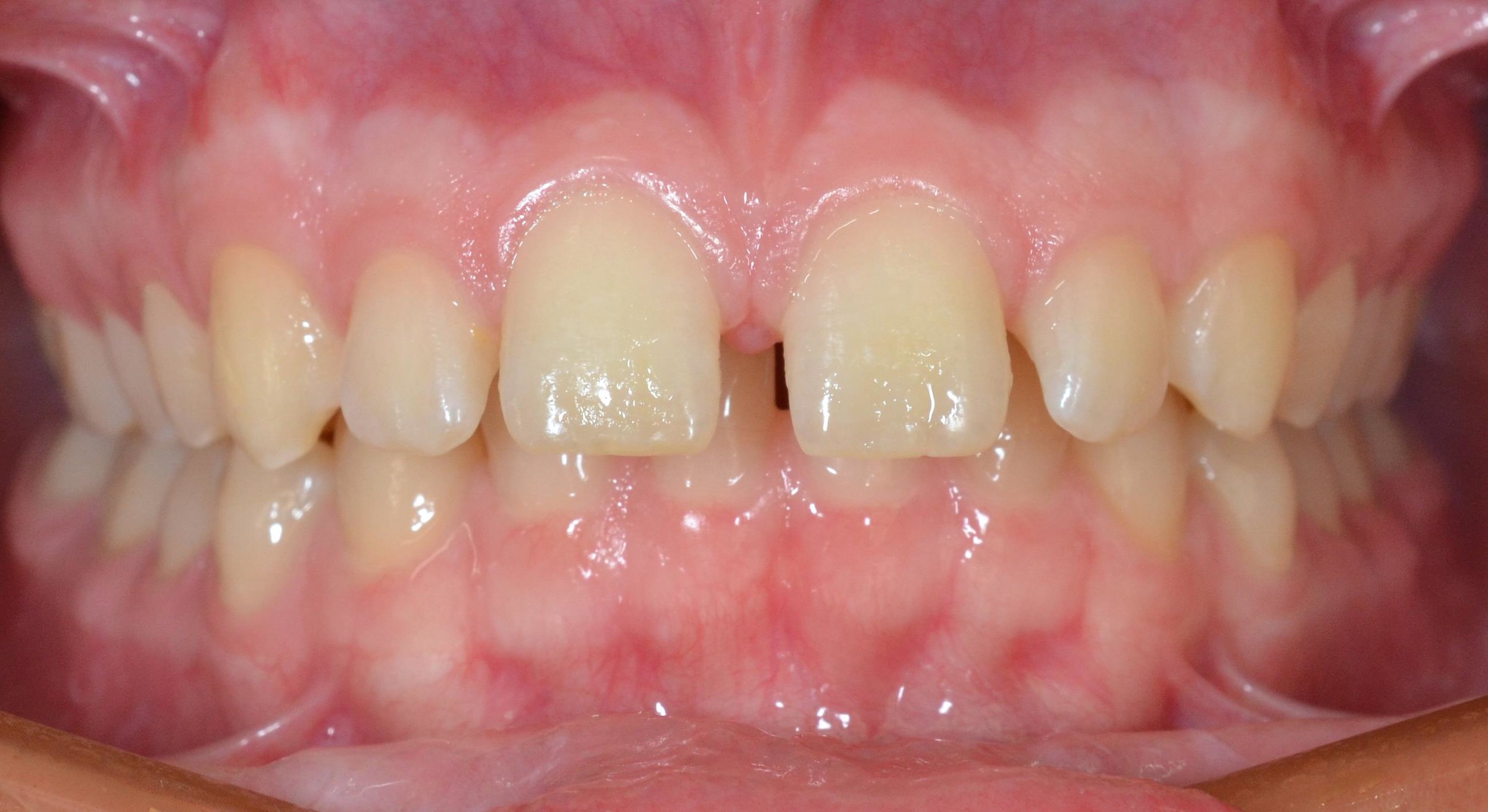 Case 2 Pre - 1527020 - Jamie Hopper - Initial - Intraoral Center.jpg