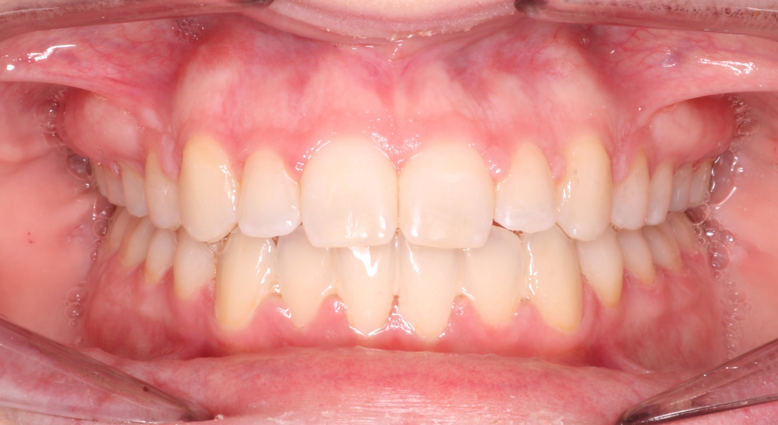 Case 5 - 1534062 - Kelsey Winnett - Final - Intraoral Center.jpg