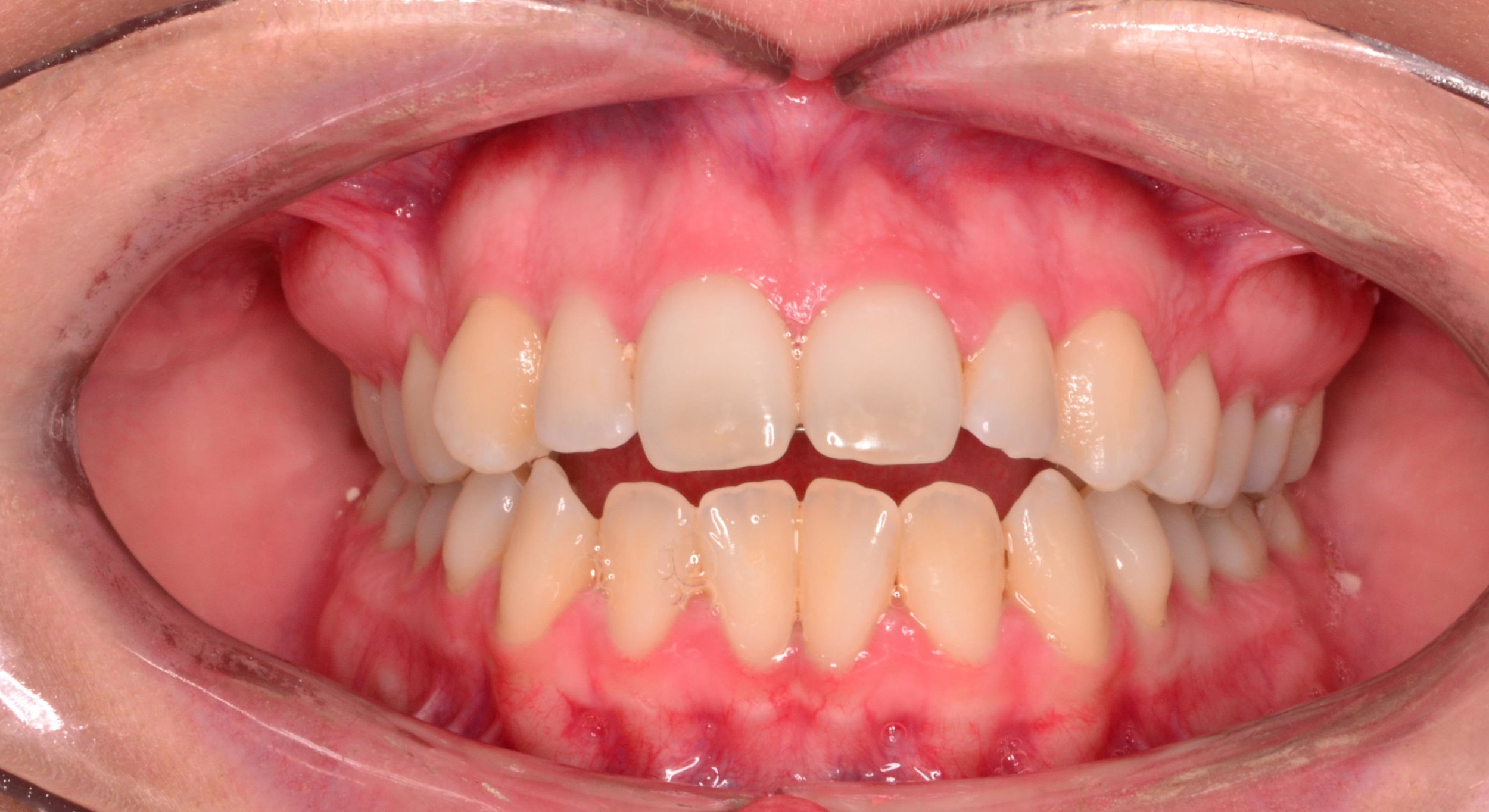 Case 5 Pre - 1534062 - Kelsey Winnett - Initial - Intraoral Center.jpg