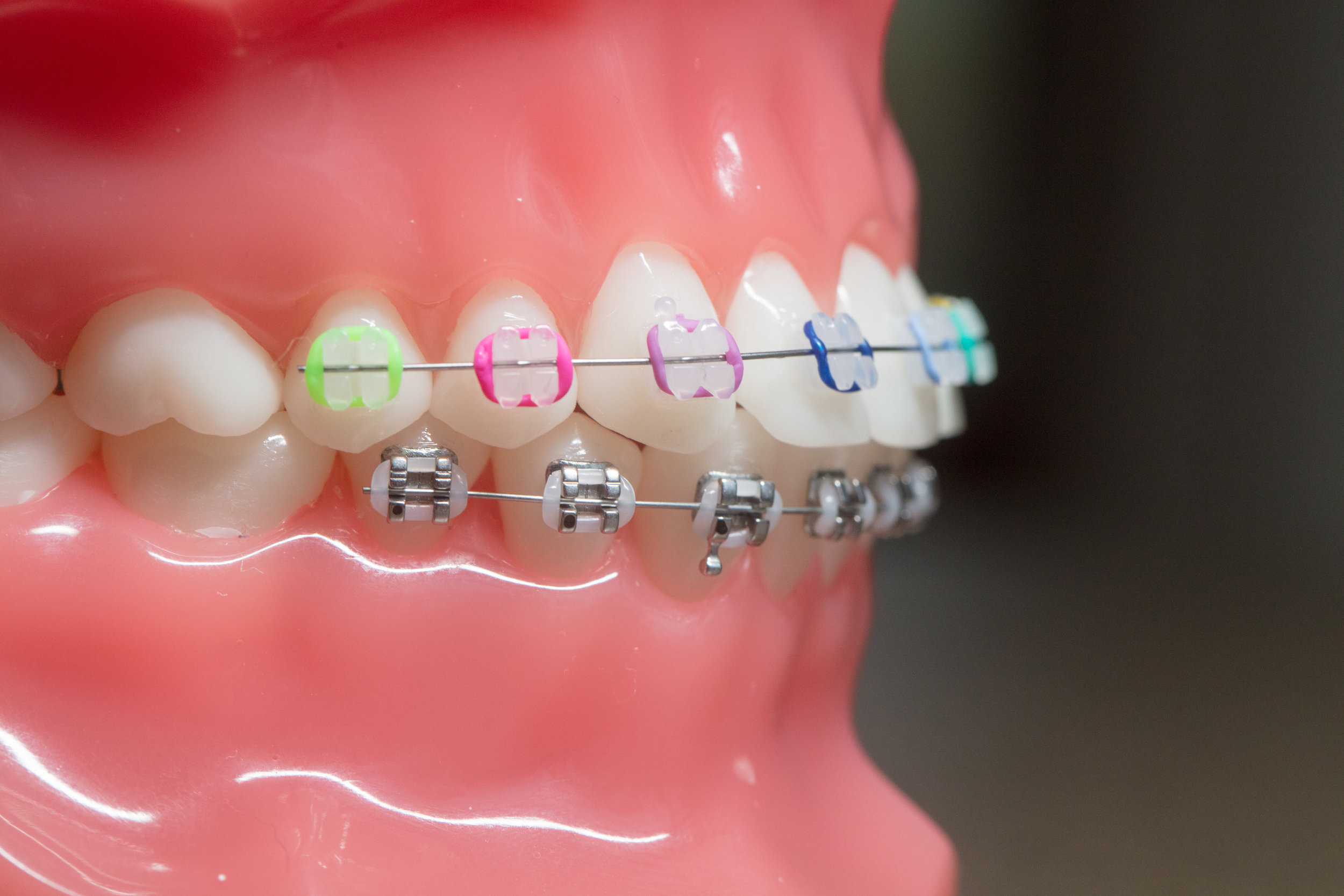 Samuelson Orthodontics - larity™ ADVANCED Ceramic Brackets with Color