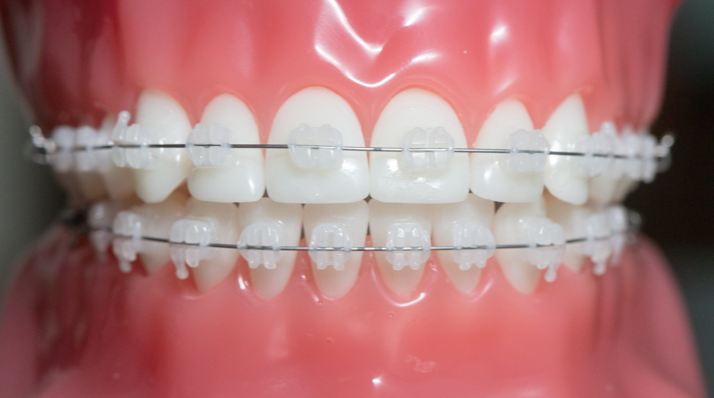 Samuelson Orthodontics - larity™ ADVANCED Ceramic Brackets