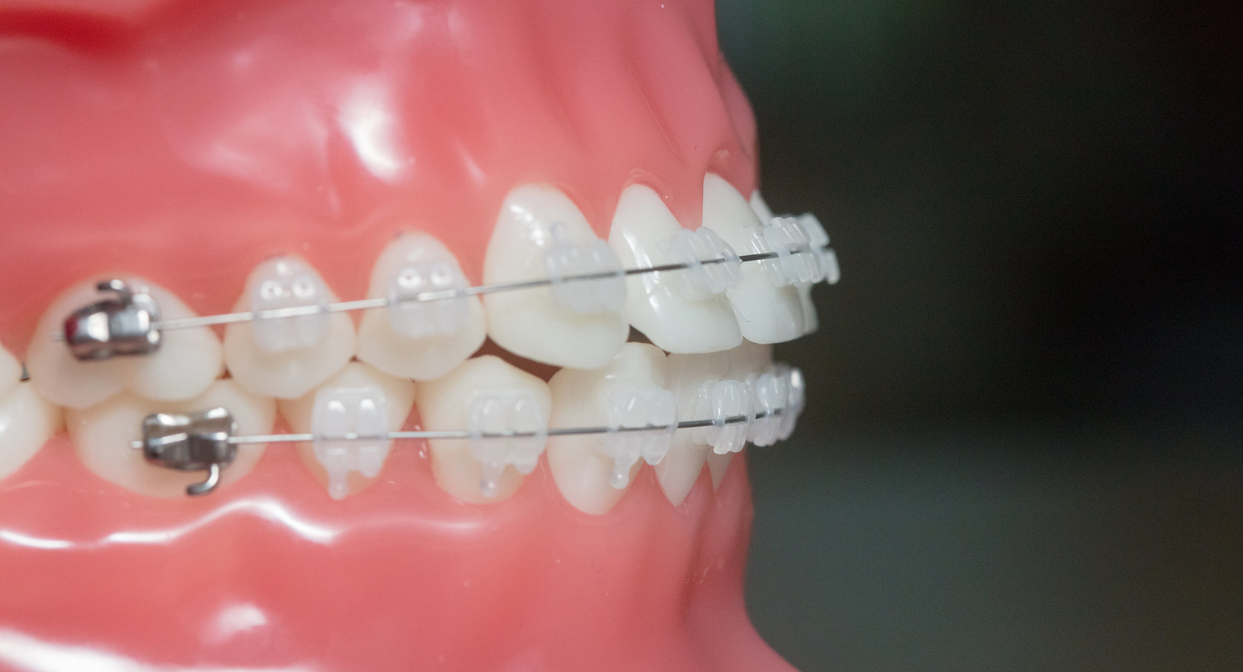 Samuelson Orthodontics - larity™ ADVANCED Ceramic Brackets