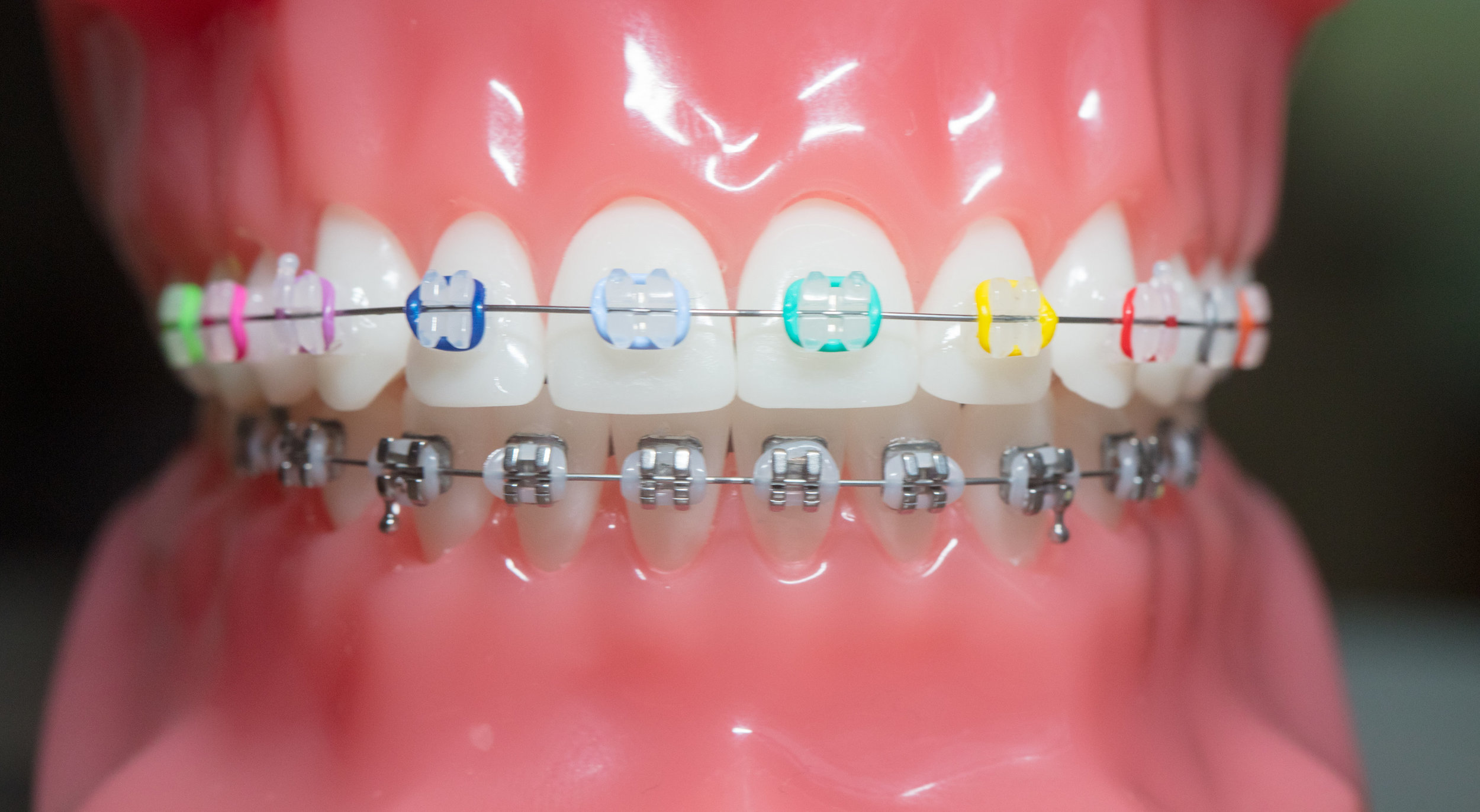 Samuelson Orthodontics - larity™ ADVANCED Ceramic Brackets with Color
