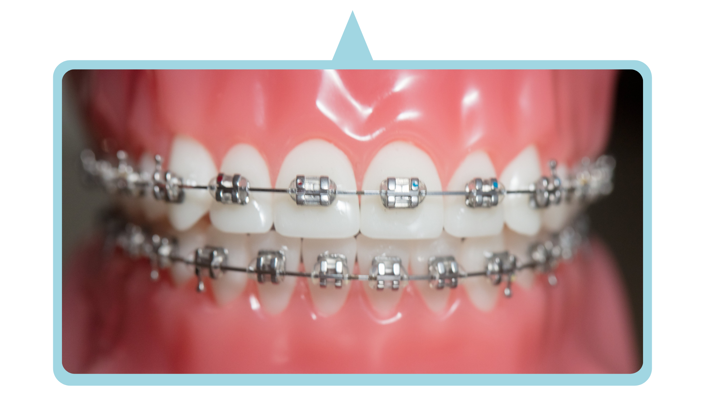 Metal Braces | Clarity 3M | Dr. Ben Samuelson | Hoover, Alabama Braces.png