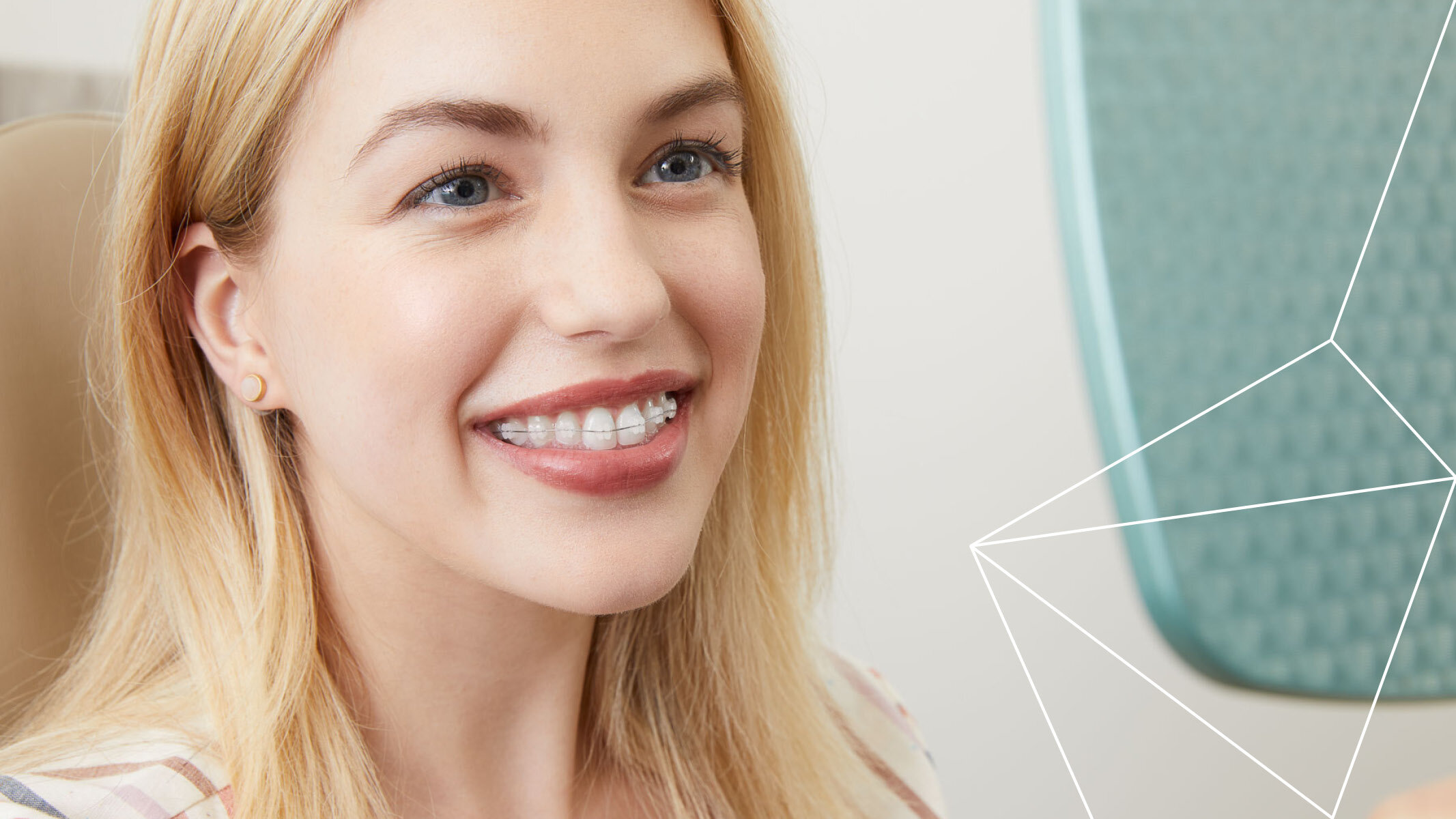 Clear Braces in Hoover — What Are Clear Braces?— Clear Braces Near Me — Clear  Braces in Alabama — Samuelson Orthodontics — Orthodontist in Hoover, AL —  Braces & Invisalign® — Orthodontist Near Me — Hoover Orthodontist