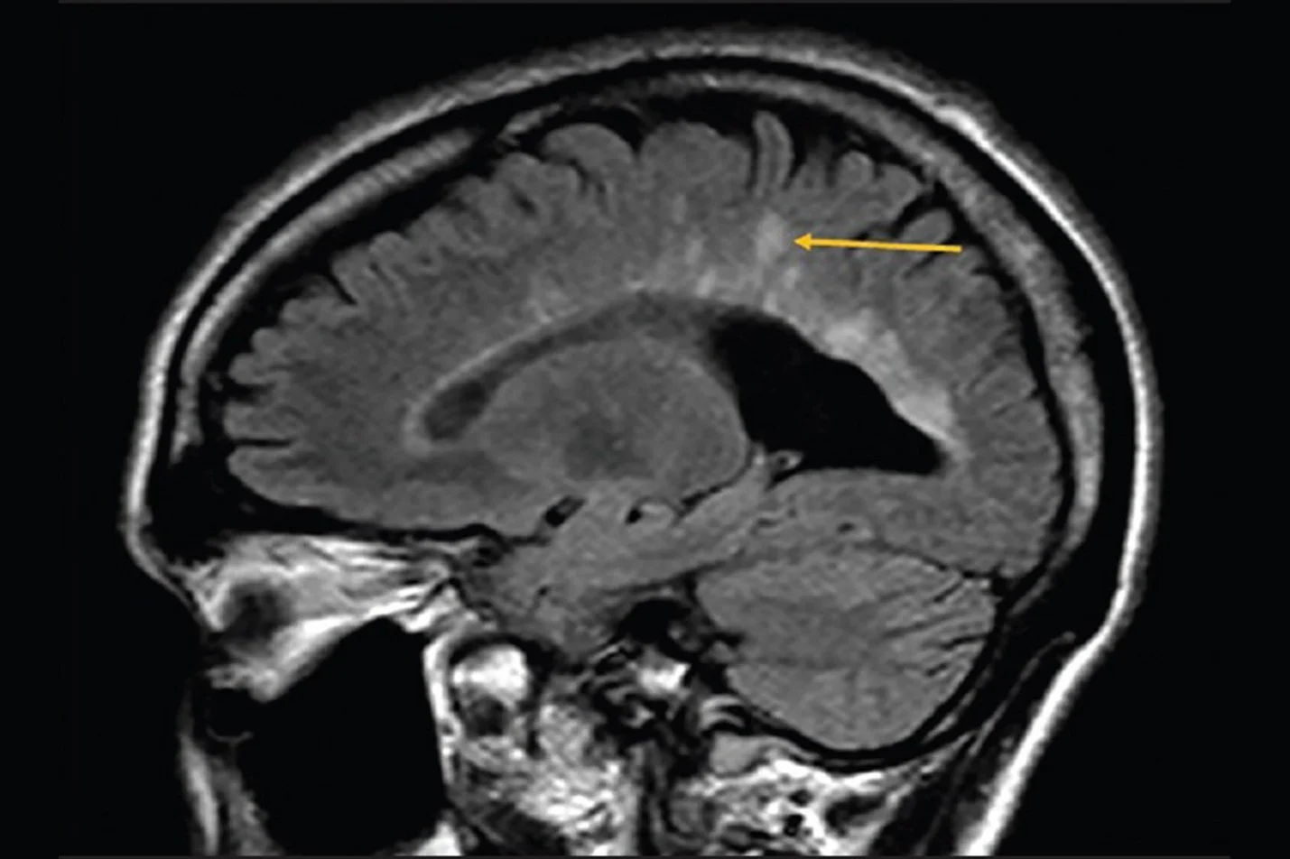 Measles, Dawson’s Disease the Morbillivirus and Multiple Sclerosis