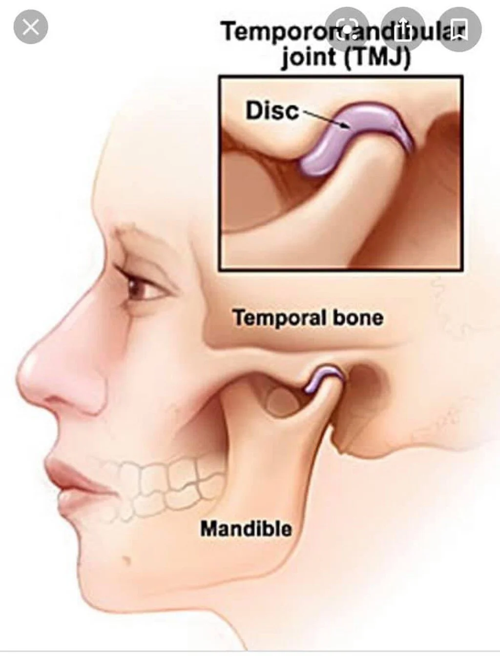 What is Temporomandibular Joint or Jaw Pain?