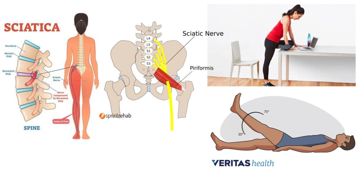 The Causes, Treatment, and Exercises for Sciatic Nerve