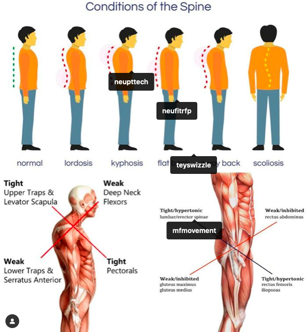 What is your natural spinal posture? � Cardiff Physio