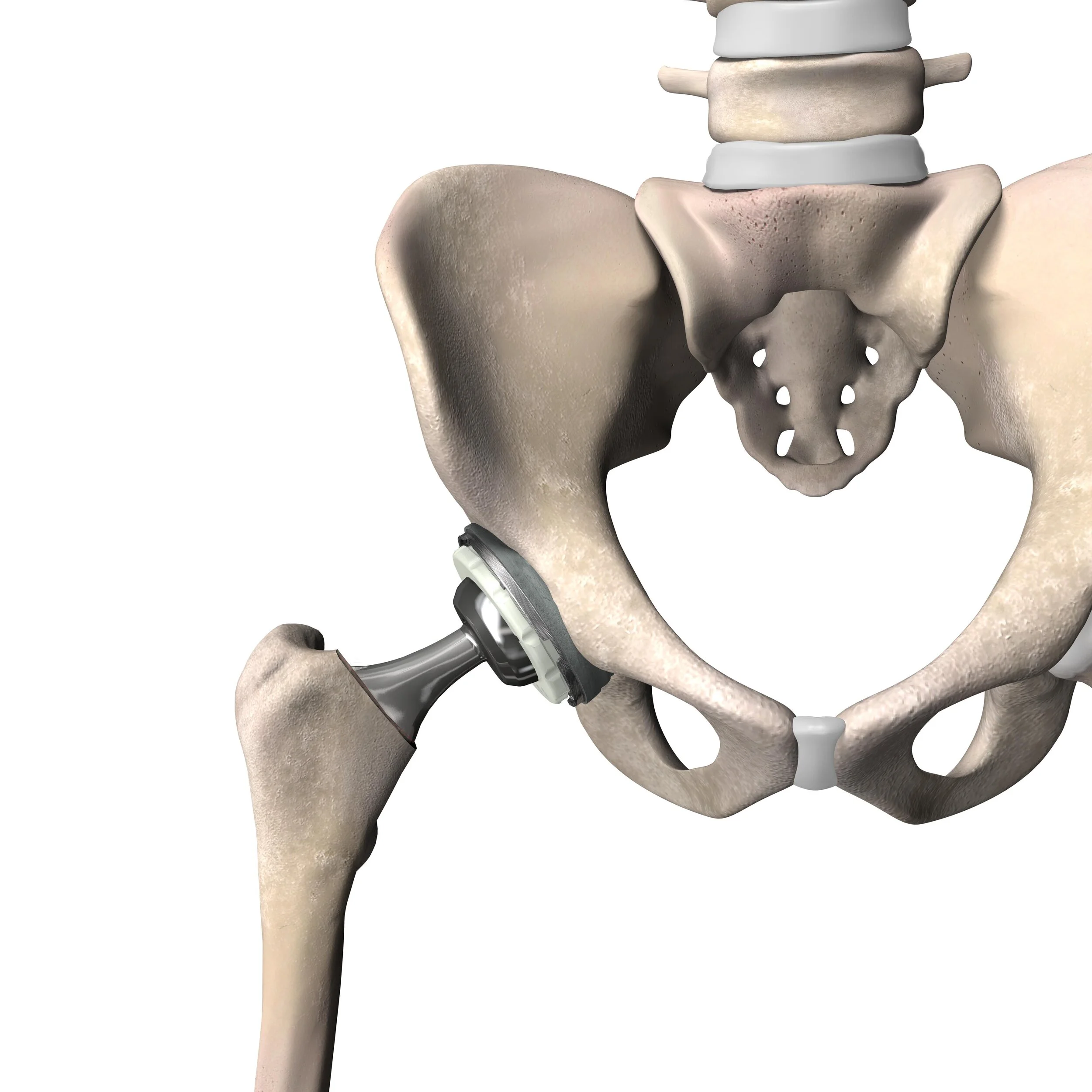Hip_Implanted.jpg