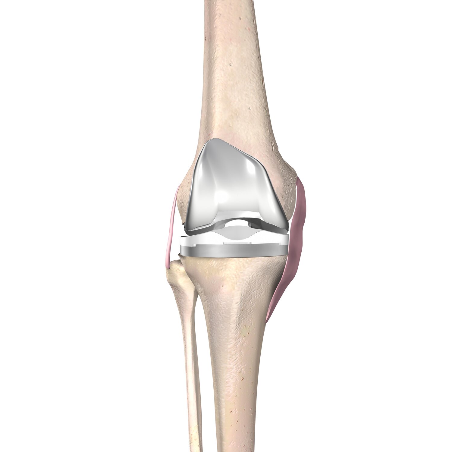 knee joint replacement devices